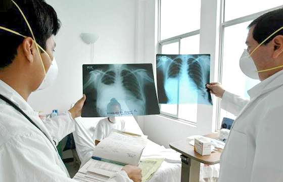 Se realizará la Semana de la Tuberculosis del 25 al 28 de marzo
