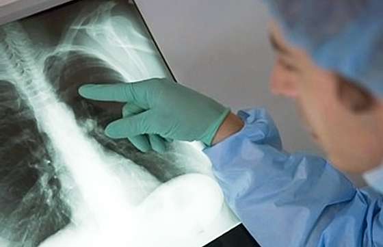 Continúan las actividades por la Semana de la Tuberculosis