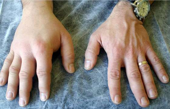 Se conmemorará el Día Internacional del Angioedema Hereditario