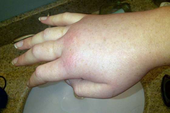 En Salta hay 17 pacientes diagnosticados con Angioedema Hereditario