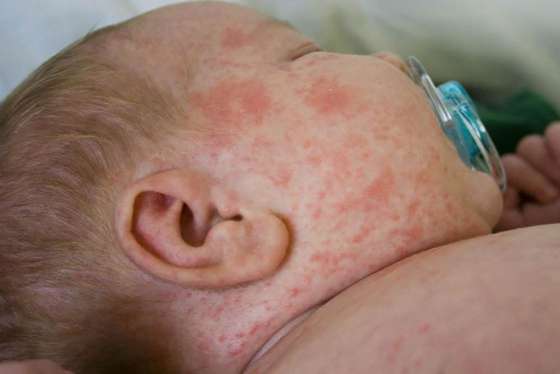 Recomiendan que los niños estén vacunados contra el sarampión