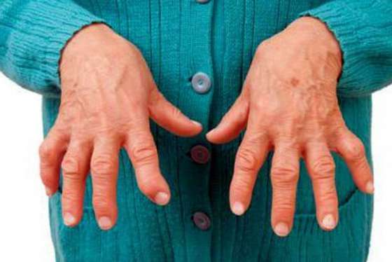 Pacientes del hospital Señor del Milagro serán evaluados para detección de artritis reumatoidea