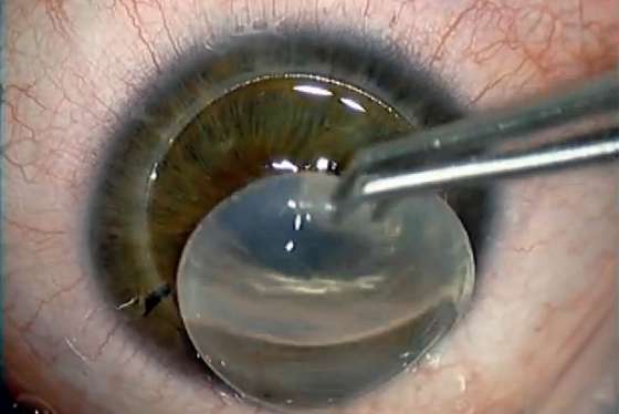 Octubre marcó un récord en donación de córneas para trasplantes en el país