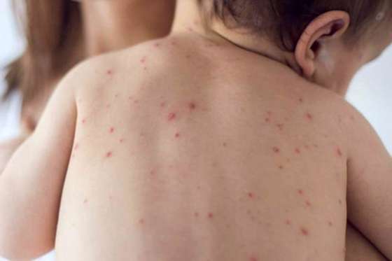 Último día para vacunar a los chicos contra el sarampión y la rubéola