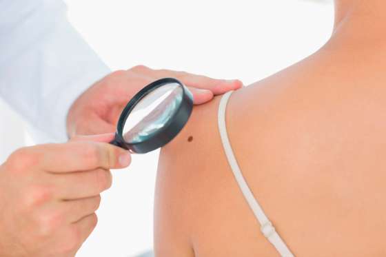 Campaña de prevención del cáncer de piel la próxima semana