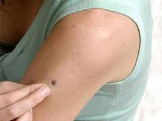 Con gran convocatoria se desarrolla  la Campaña de Prevención del Cáncer de Piel