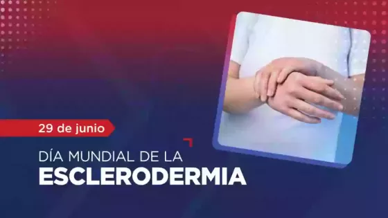 La esclerodermia es una afección reumática que afecta mayormente a las mujeres