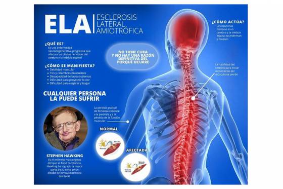 Hoy es el Día Mundial de la Esclerosis Lateral Amiotrófica