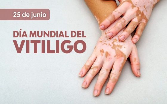 El vitiligo es ocasionado por un error del sistema inmunitario y no es contagioso