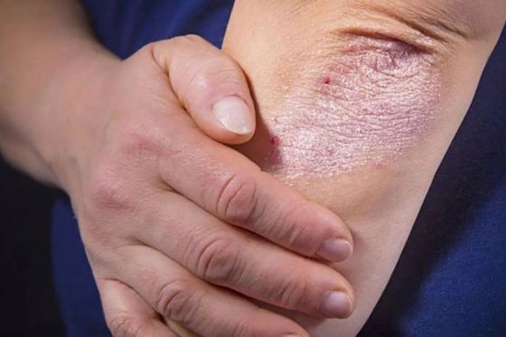 Hoy se hará detección de enfermedad psoriásica en el hospital San Bernardo