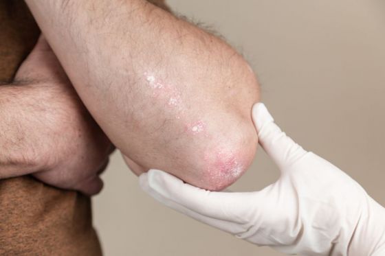 Pacientes con enfermedad psoriásica son asistidos en el hospital San Bernardo