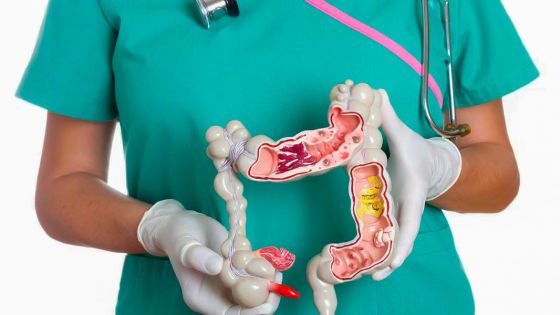 El cáncer de colon y recto detectado a tiempo es altamente curable